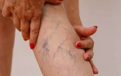 Varicose Veins Diagnosis Management and Treatment