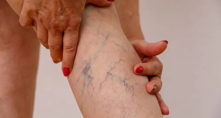 Diagnosis, Management of Varicose Veins Treatment in Mumbai