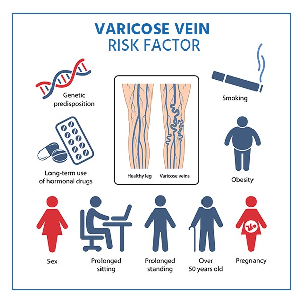 risk factors for varicose veins