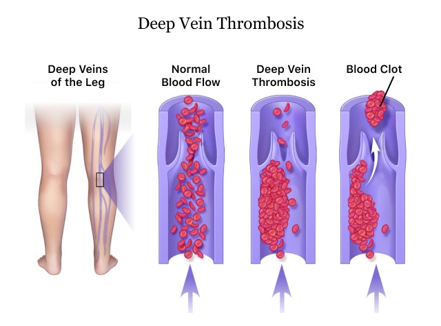 Deep vein thrombosis