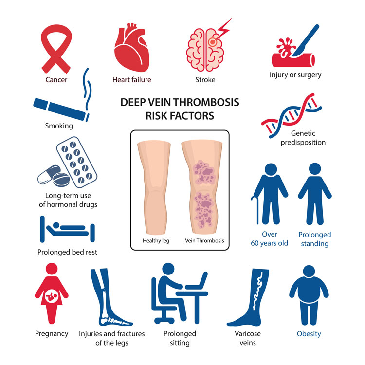 risk factors of deep vein thrombosis