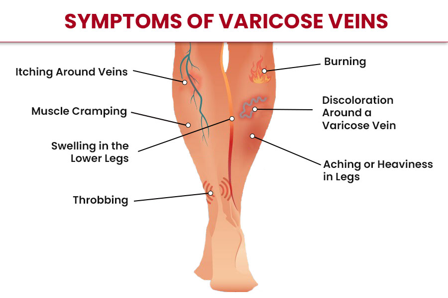 varicose veins treatment in Mumbai