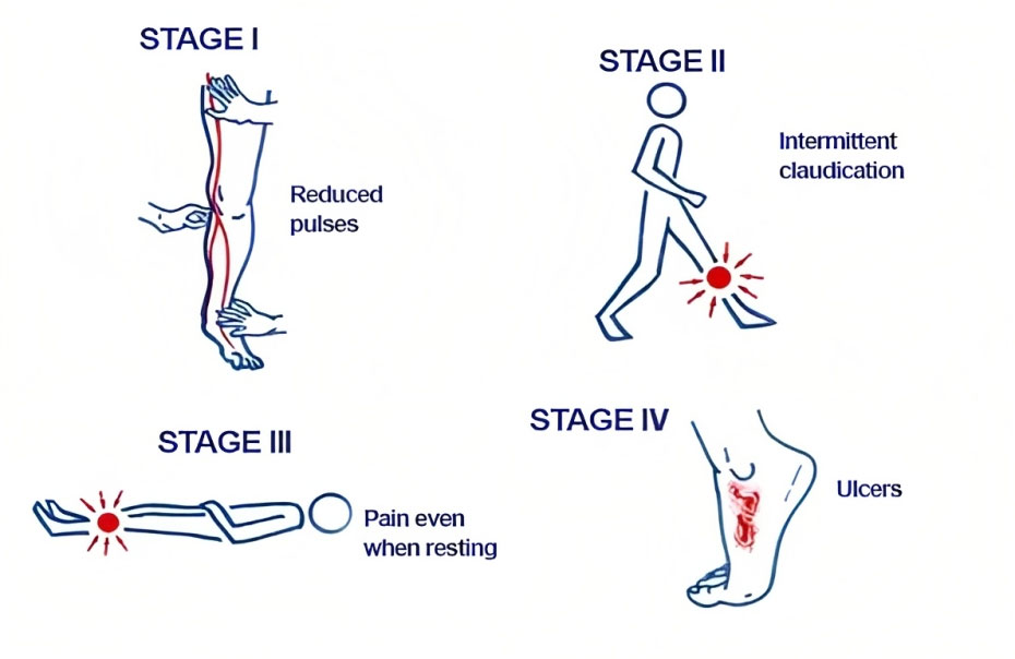 Stages of peripheral artery disease