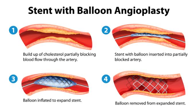Stent with balloon angioplasty