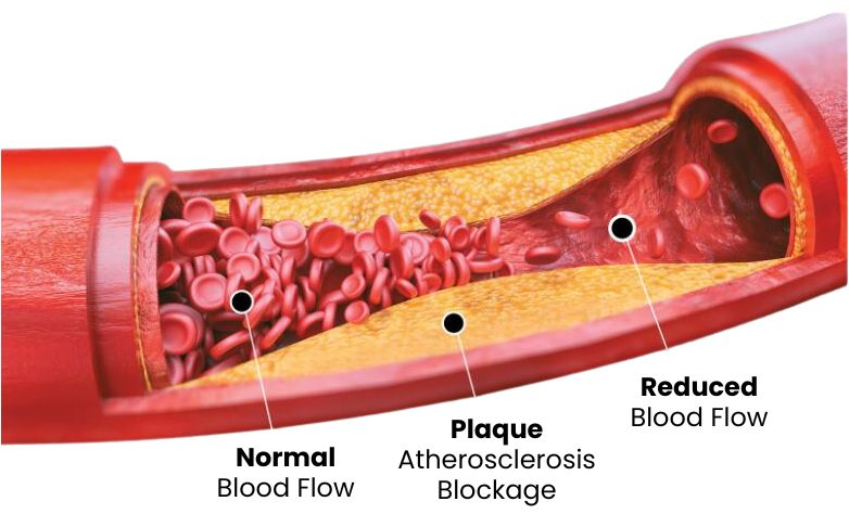 Causes of  peripheral arterial disease