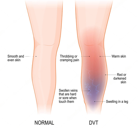 sign-Symptoms-of-deep-vein-thrombosis