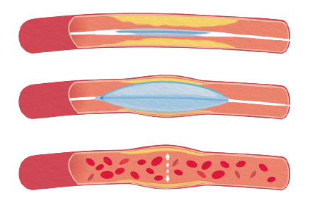what is angioplasty