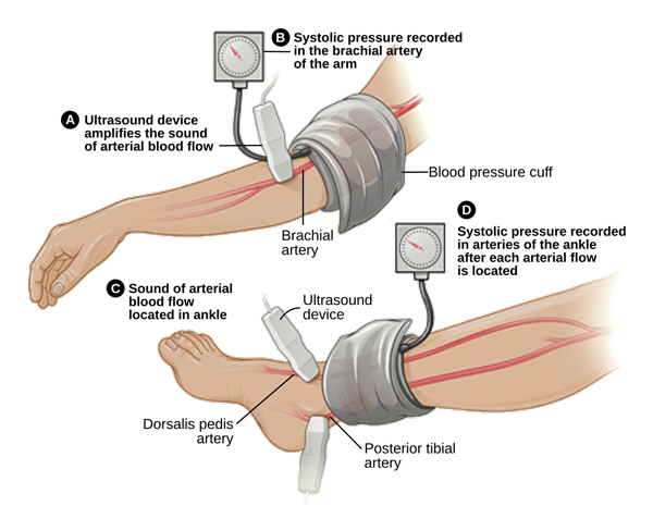 Ankle–brachial pressure index