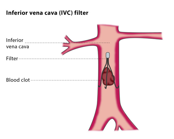 inferior vena cava filter