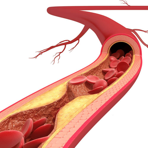 peripheral vascular disease