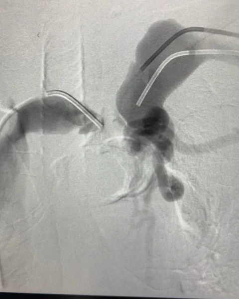 Central Venous Angioplasty
