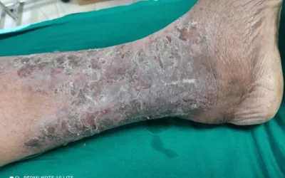 Varicose Veins Eczema and Dermatitis