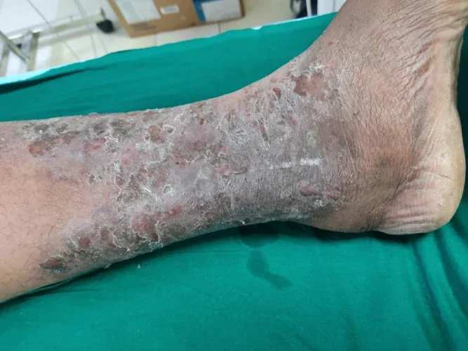Varicose Veins Eczema and Dermatitis