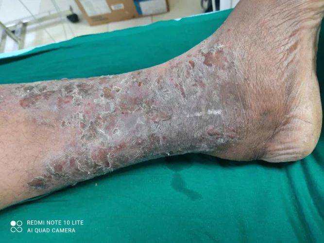 Varicose Veins Eczema and Dermatitis