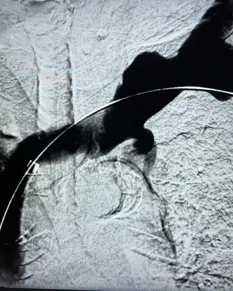 Central Venous Angioplasty