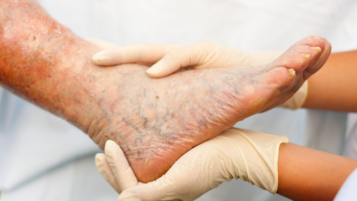 Varicose Vein Treatment in Borivali