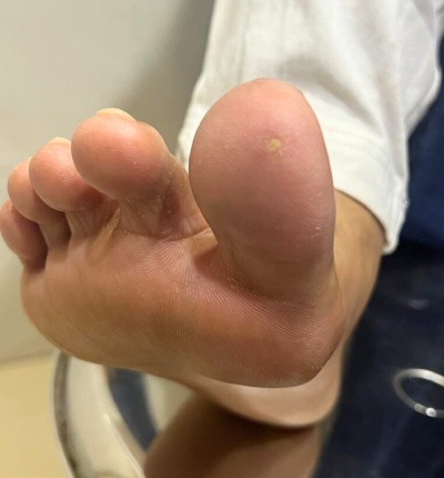 Diabetic Foot Treatment in Mumbai, India - Dr. Kunal Arora