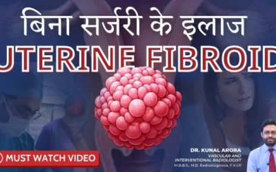 Uterine Fibroids Treatment Without Surgery in Mumbai