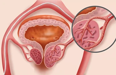 embolization fibroid bronchial artery prostate