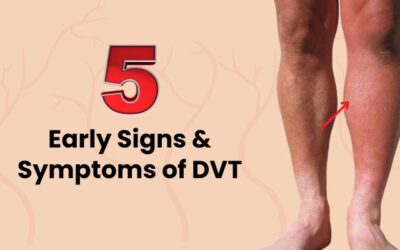 5 Early Signs & Symptoms of Deep Vein Thrombosis (DVT)