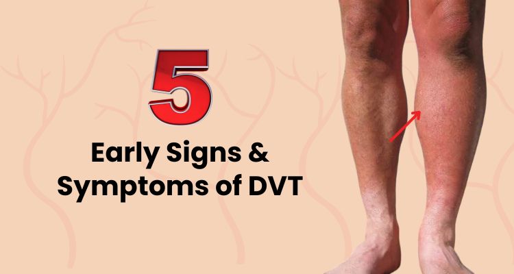 5 Early Signs & Symptoms of Deep Vein Thrombosis (DVT)