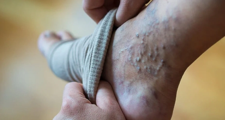 Varicose Veins Early Stage Symptoms & Detection