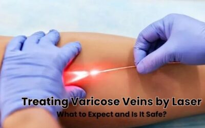 EVLA for Varicose Veins: Safe, Effective & What to Know