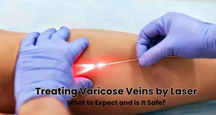 Treating Varicose Veins by Laser