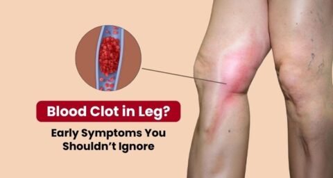 Blood Clots In Leg Early Signs Symptoms You Need To Know blood-clots-in-leg-early-signs-symptoms-you-need-to-know