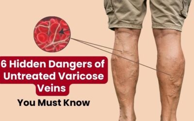 6 Hidden Dangers of Untreated Varicose Veins You Must Know
