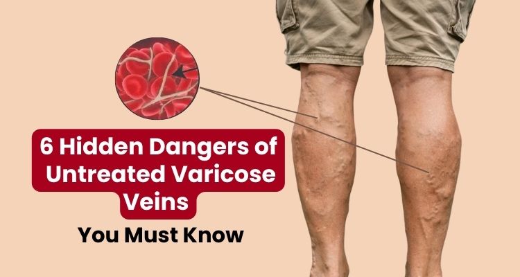 6 Hidden Dangers of Untreated Varicose Veins You Must Know