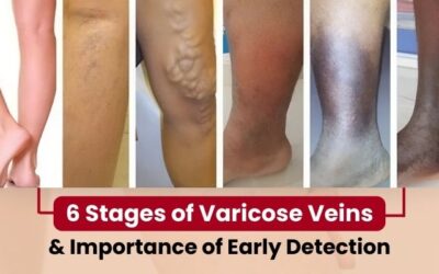 6 Stages of Varicose Veins and Importance of Early Detection