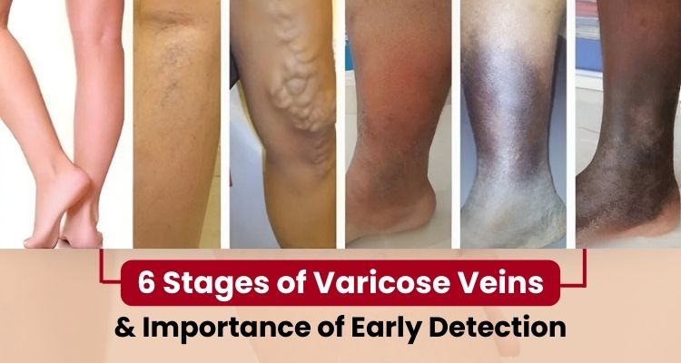 6 Stages of Varicose Veins