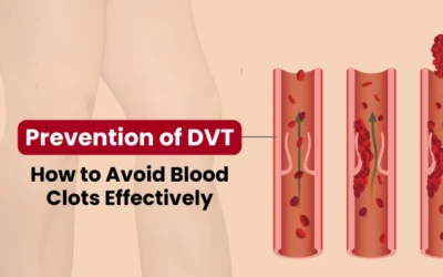 Prevention of DVT: How to Avoid Blood Clots Effectively
