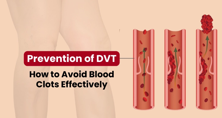 Prevention of DVT: How to Avoid Blood Clots Effectively