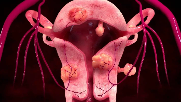 Uterine Fibroid Embolization