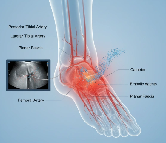 Plantar Fasciitis Embolisation in Mumbai Plantar Fasciitis Embolisation in Mumbai