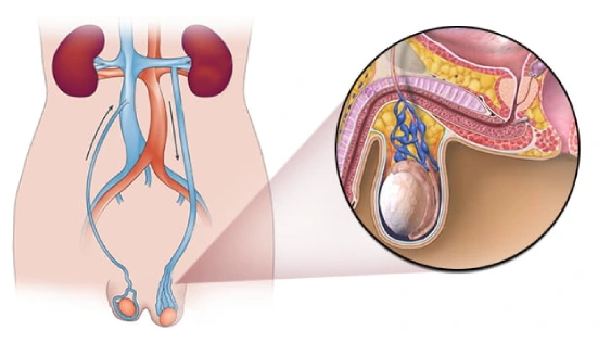 Varicocele Embolization in Mumbai