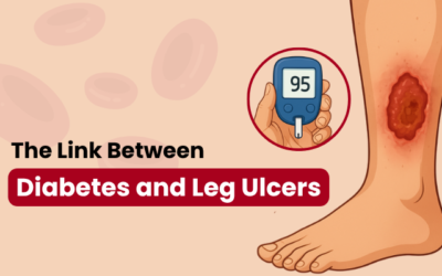 The Link Between Diabetes and Leg Ulcers