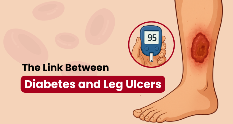 embolus The Link Between Diabetes and Leg Ulcers