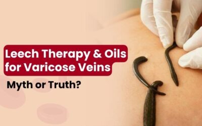 Leech Therapy & Oils for Varicose Veins: Myth or Truth?