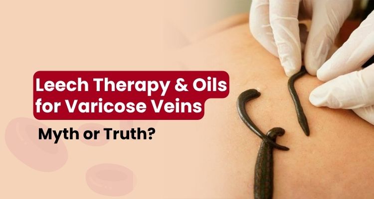 leech therapy oils varicose veins facts vs myths