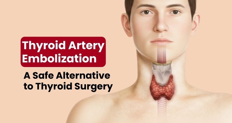 Thyroid Artery Embolization: A Safe Alternative to Thyroid Surgery Thyroid Artery Embolization: A Safe Alternative to Thyroid Surgery