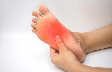 Plantar Fasciitis Embolisation Plantar Fasciitis Embolisation