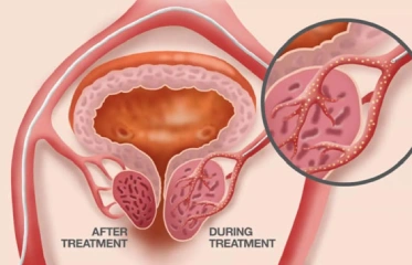 Prostatic Artery Embolisation