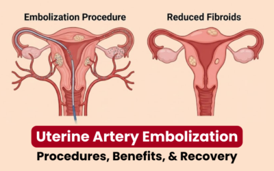 Uterine Artery Embolization – Procedures, Benefits, & Recovery