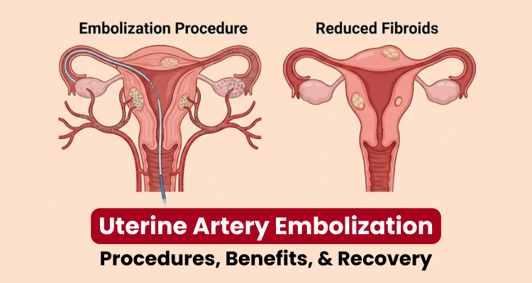 Uterine Artery Embolization – Procedures, Benefits, & Recovery Uterine Artery Embolization - Procedures, Benefits, & Recovery