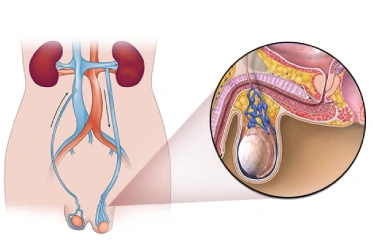 Varicocele Embolization Varicocele Embolization in Mumbai<br />