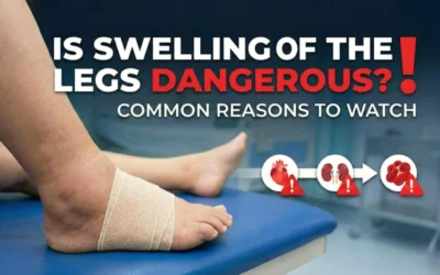 Is Swelling of the Legs Dangerous? Common Reasons to Watch