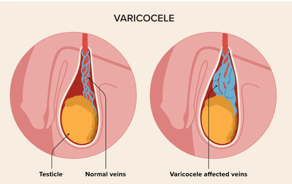 Varicocele Treatment in Andheri<br />
